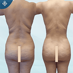 tummy-tuck-revision-3
