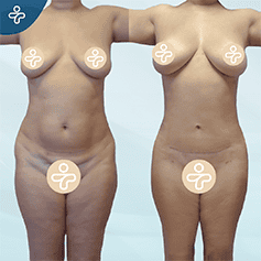 tummy-tuck-revision