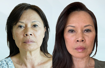 Facelift in Turkey Before and After Patient