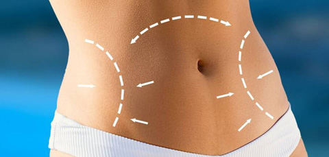 Illustration of abdominal contour with arrows showing areas treated in different types of tummy tuck procedures