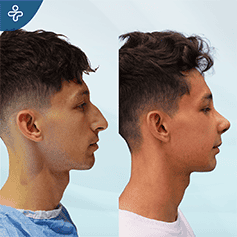ultrasonic-rhinoplasty-2