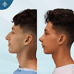 ultrasonic-rhinoplasty-3