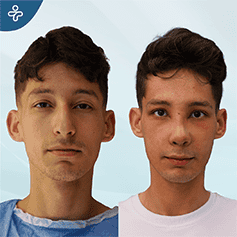 ultrasonic-rhinoplasty