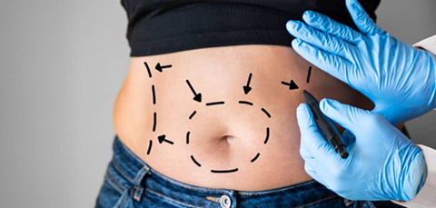 Doctor marking abdomen during bariatric surgery consultation discussing weight loss surgery safety in Turkey