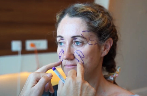 facial procedure with pointing to areas near her nose and cheeks
