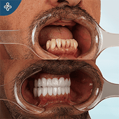 zygomatic-implants-2