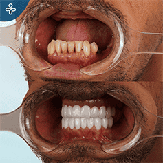 zygomatic-implants-3