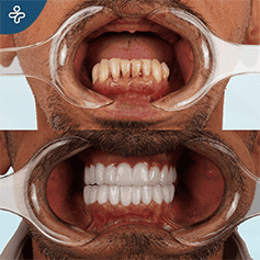 zygomatic-implants