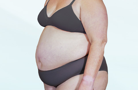 Side view of woman with obesity before biliopancreatic diversion with duodenal switch surgery