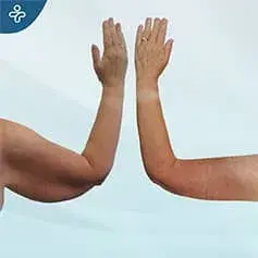 Reducción de brazos antes y después
