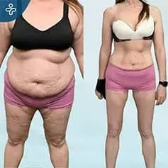 Antes y Después de la Cirugía Bariátrica