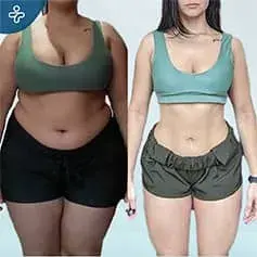 Antes y Después de la Cirugía de Bypass Gástrico