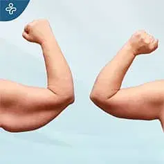 Lifting extendido de brazos antes y después de la cirugía