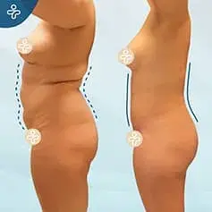Liposuktion + Abdominoplastik Vorher und Nachher