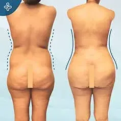 Erweiterte Bauchdeckenstraffung Vorher und Nachher