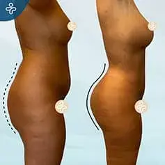 Hourglass BBL Before and After in Turkey