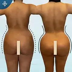 Hourglass BBL Before and After in Turkey