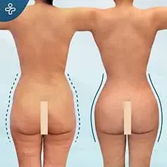 Bubble Butt BBL Before and After