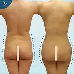 Heart Shaped Butt BBL Before & After