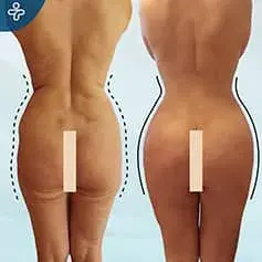 Brazilian Butt Lift Before and After