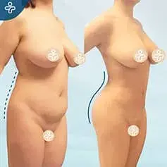BBL + Mini Tummy Tuck Before & After