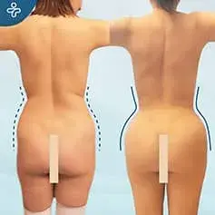 BBL + Mini Tummy Tuck Before & After