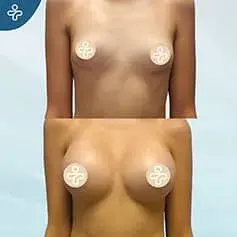 Vorher und Nachher Anatomische Implantate