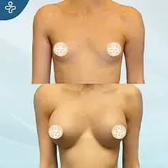Hoch+ Projektion Implantat Vorher & Nachher