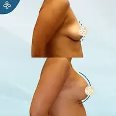 Konturierte Implantate Vorher & Nachher