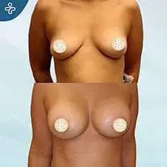Konturierte Implantate Vorher & Nachher