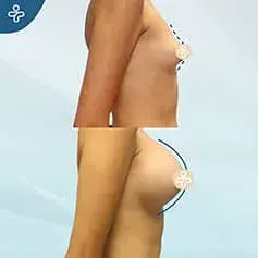 Hochprojizierende Anatomische Implantate Vorher Nachher