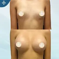Hochprojizierende Anatomische Implantate Vorher Nachher