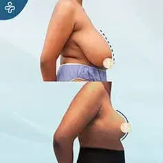 XXXL Extended Breast Uplift Before and After