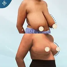 Réduction Mammaire Étendue XXXL