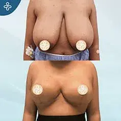 Réduction Mammaire Étendue XXXL
