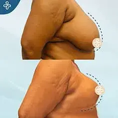 Avant et Après Réduction XL