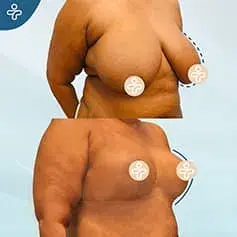 Avant et Après Réduction XL