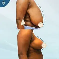 Réduction Mammaire Étendue +XXXL