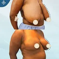 Réduction Mammaire Étendue +XXXL