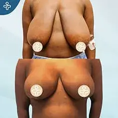 Réduction Mammaire Étendue +XXXL