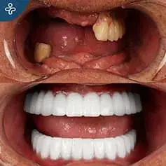 Impianti Dentali Completi in Turchia Prima e Dopo