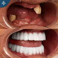 Impianti Dentali Completi in Turchia Prima e Dopo