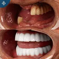 Impianti Dentali Completi in Turchia Prima e Dopo