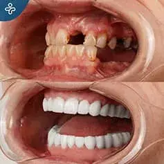 Ristrutturazione Completa del Sorriso Hollywoodiano