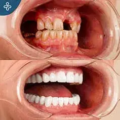 Ristrutturazione Completa del Sorriso Hollywoodiano