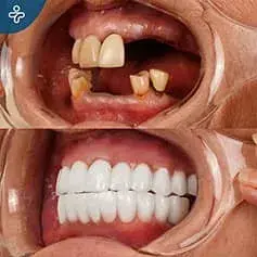 Impianti Dentali Svizzeri in Turchia Prima e Dopo