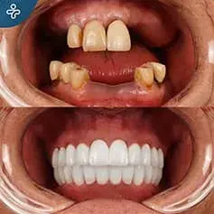 Impianti Dentali Svizzeri in Turchia Prima e Dopo