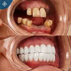 Impianti Dentali Svizzeri in Turchia Prima e Dopo