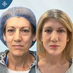 Before After
