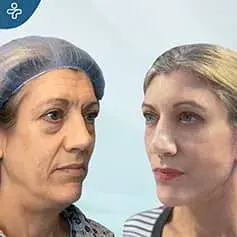 Lifting SMAS étendu avant et après